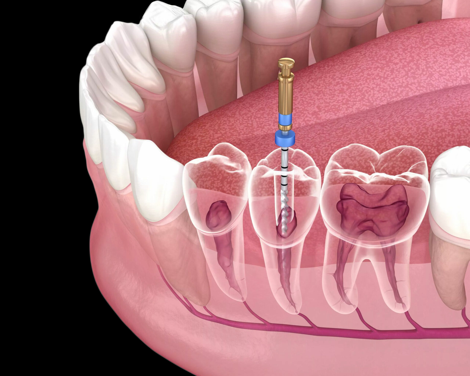 How Is the Molar Root Canal Therapy?